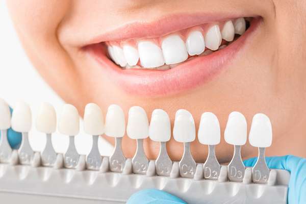 Ask a Cosmetic Dentist: What Are Veneers from Fashion Isle Smiles in Newport Beach, CA