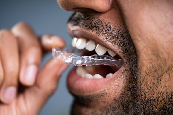 A Cosmetic Dentist Explains Benefits of Clear Aligners from Fashion Isle Smiles in Newport Beach, CA
