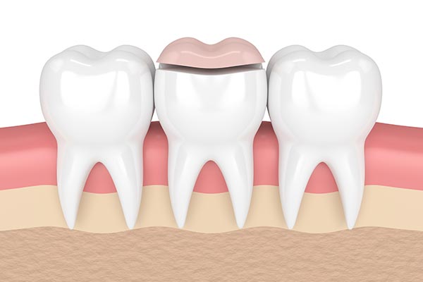 How a Cosmetic Dentist Can Place Inlays and Onlays from Fashion Isle Smiles in Newport Beach, CA