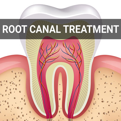 Navigation image for our Root Canal Treatment page